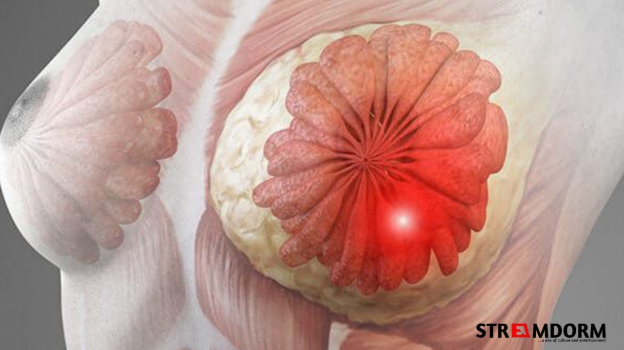 Understanding Breast Cancer: Awareness, Risks, and Prevention